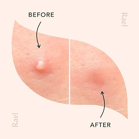 Rael Pimple Patches, Miracle Invisible Spot Cover - Hydrocolloid Acne Pimple Patches for Face, Blemishes and Zits Absorbing Patch, Breakouts Spot Treatment for Skin Care, Facial Stickers, 2 Sizes (96 Count)