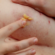 Load image into Gallery viewer, Beeswax &amp; Propolis Magic Salve | Universal Skin Healer | Boils | Abscesses | Hidradenitis Suppurativa | Anal Fissures | Wound Care | Healing For Painful, Irritated, Infected, Open, Dry &amp; Cracked Skin