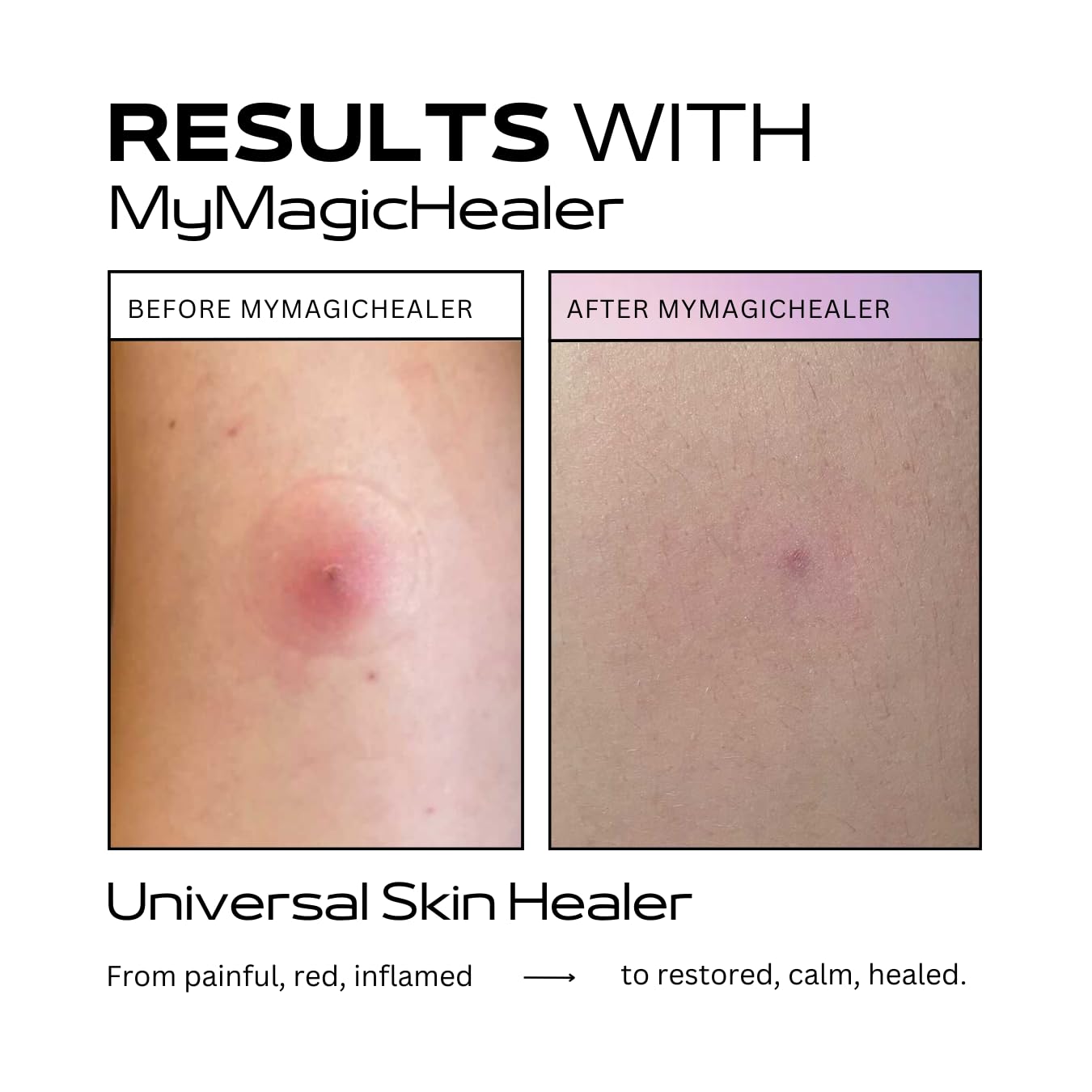 Beeswax & Propolis Magic Salve | Universal Skin Healer | Boils | Abscesses | Hidradenitis Suppurativa | Anal Fissures | Wound Care | Healing For Painful, Irritated, Infected, Open, Dry & Cracked Skin