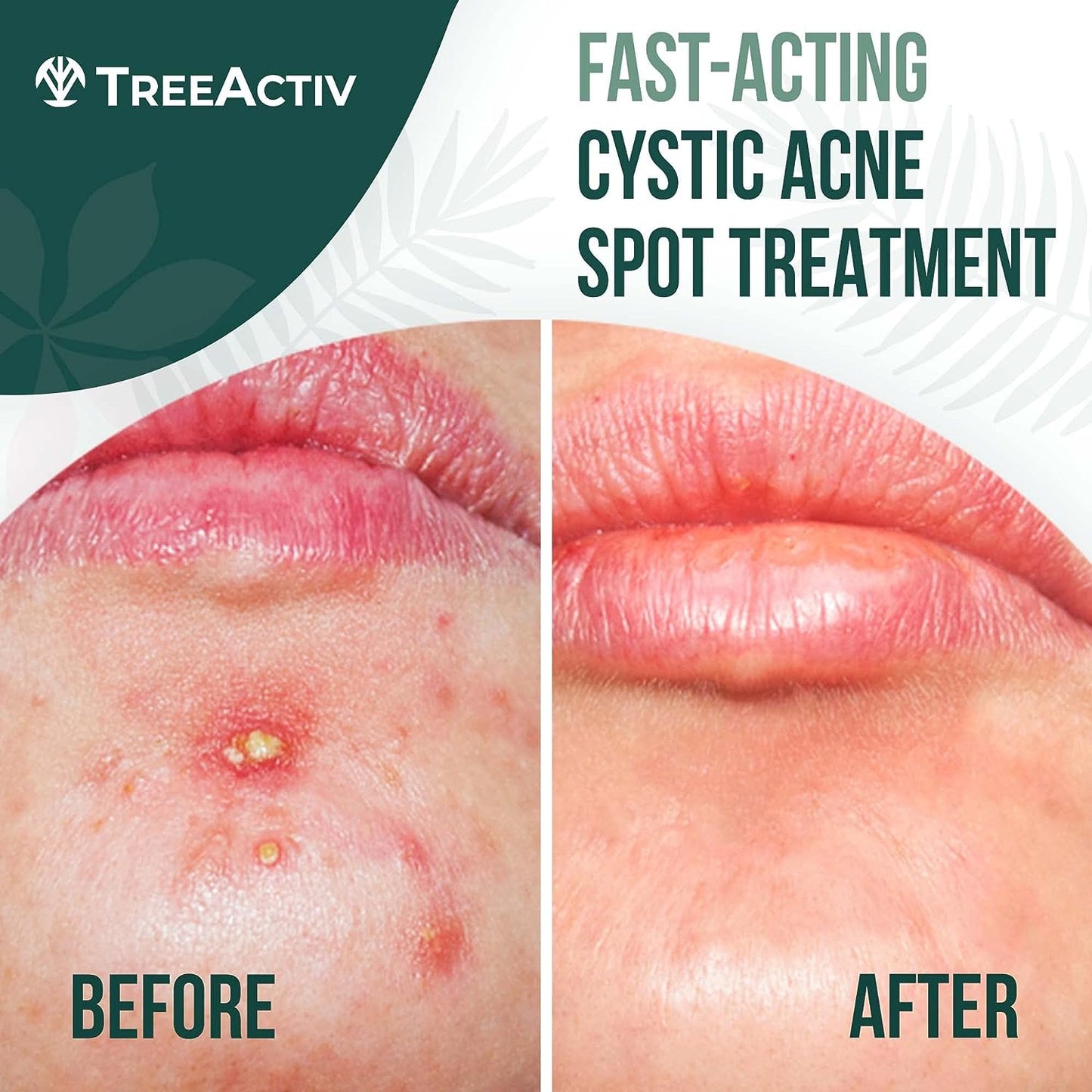 TreeActiv Cystic Acne Spot Treatment, Hormonal Acne Treatment & Overnight Sulfur Cystic Acne Treatment For Face, Pimples, and Blemishes for Adults, Men, and Women - 0.5oz 120+ Uses